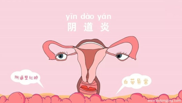 阴道炎
